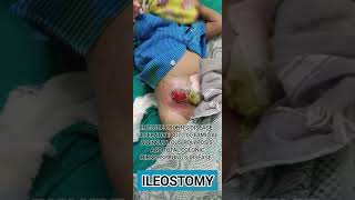 Ileostomy  indication where it is donesurgery [upl. by Lucilla]