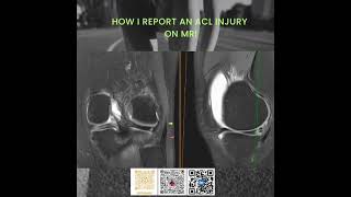 ACL Injury MRI Key Insights for Effective Treatment  Dr Gaurav Vashisht radiologist radiology [upl. by Cassady263]