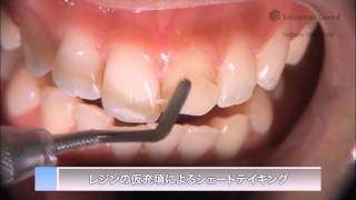 ESTELITE ASTERIA Klinische Anleitung DE  Tokuyama Dental [upl. by Aysa]