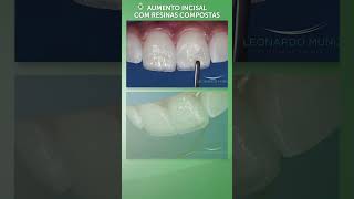 Aumento Incisal com Resinas Compostas [upl. by Delaney]