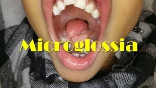 A Rare Case of Microglossia [upl. by Asillam704]