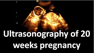 Ultrasonography of 20 weeks pregnancy  Sonographic findings [upl. by Kisor]