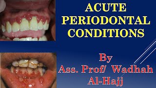 15Periodontal diseases5Acute periodontal infectionsDr Wadhah Periodontology lecturesوضاح الحاج [upl. by Alejandro]