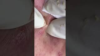 Big Cystic Acne Blackheads Extraction Blackheads amp Milia Whiteheads Removal Pimple Popping [upl. by Neffirg]