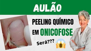 Aulão Peeling Químico em Onicofose Será que Funciona [upl. by Yanahs]