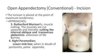 Conventional Appendectomy or Open Appendectomy  Benefits Procedure Indications [upl. by Mahau]