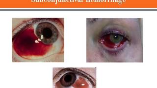 Subconjunctival Hemorrhage [upl. by Orsola995]