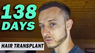 FUE Hair Transplant 138 Days post op Istanbul Turkey GROWTH STAGE [upl. by Daugherty844]