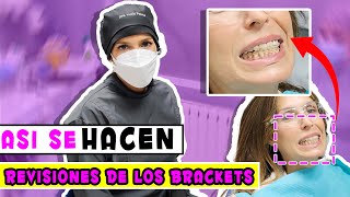 🔴 En Vivo  Proceso de AJUSTE DE BRACKETS 👉¿Qué te hacen en la REVISIÓN de ORTODONCIA [upl. by Aiclef]