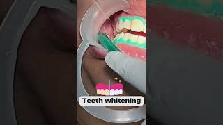 Step By Step Teeth Whitening Process  Happy Smiles Dental Care  DCH [upl. by Jeggar]