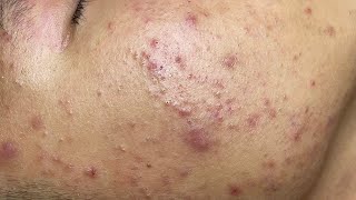 ACNE TREATMENT VU QUYNH MI Acne On Boys Cheek 2024 [upl. by Bessie22]