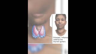 Learn Thyroid gland hypothyroidismclass 11 part2 trendingshortsneet science factseducation [upl. by Anitsirc821]