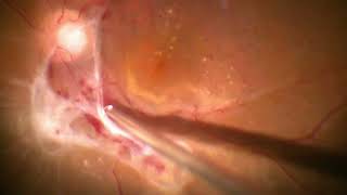 Vitrectomy for PDR in TRD  Proliferative Diabetic Retinopathy with TRD  Dr Manish Nagpal [upl. by Kuebbing]