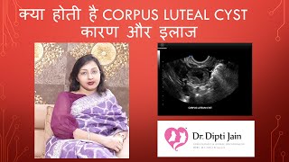 क्या होती है CORPUS LUTEAL CYST कारण और इलाज HINDI [upl. by Jezreel867]