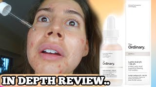 I TESTED THE ORDINARY LACTIC ACID FOR MY ACNE SCARS FOR 3 WEEKS THIS IS WHAT HAPPENED [upl. by Edualcnaej]