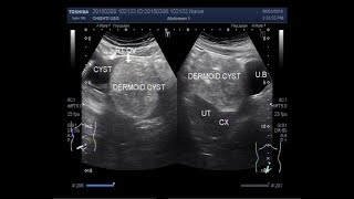 Ultrasound Video showing a simple ovarian cyst and a Dermoid ovarian cyst [upl. by Rimma412]