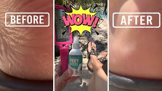 Get Rid of CRACKED HEELS Fast with this Foot Peeling Spray amp File [upl. by Wolram]