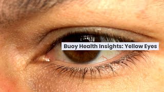 Yellow Eyes Common Causes and When to Seek Medical Care  BuoyHealthcom [upl. by Fidela]