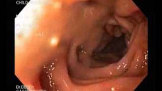 Gastroscopy  gastritis hyperemia and esophagitiswmv [upl. by Otinauj]