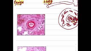 pathology of renal vascular system Hypertension 2 [upl. by Heddi]