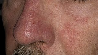 How to Treat Eczema on Face  Seborrheic Dermatitis Treatment  Face Eczema Treatment [upl. by Zetra]