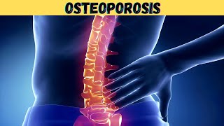 What is Osteoporosis 3d animation  pathophysiology symptoms causes  estrogen  old age  kya hindi [upl. by Penrod]