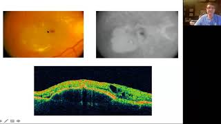 Retinal OCT for Clinicians [upl. by Aidahs]