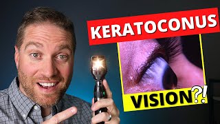 What Is Vision Like With Keratoconus And Irregular Astigmatism [upl. by Roux]