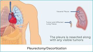 Pleurectomy With Decortication PD  Mesothelioma Guide [upl. by Anirbak]