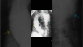 Syphilitic Aneurysm Aortography RadiologyAscending and Descending Aorta calcified Awerenes of all [upl. by Kentiggerma]