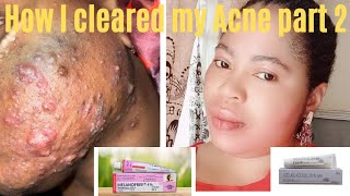 how I cleared my Acne dark spots in 7days part 2 how to use melano free creamdarkspotmelanofree [upl. by Enelyaj]