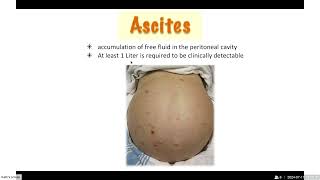 Ascites [upl. by Undry586]