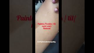 Painless freckles  mole til wart removal freckles mole warts treatment healthtipsinhindi yt [upl. by Annyrb]