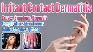 Irritant contact dermatitis overview causes symptoms treatment options and home remedies [upl. by Nosneh]