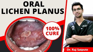 Oral Lichen Planus 100 Cure  How to Cure Lichen Planus Naturally amp Permanently At Home  JYOVIS [upl. by Lauritz25]