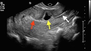 Non Tubal Ectopic Pregnancies [upl. by Mcconnell]