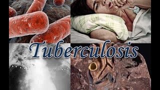 Tuberculosis [upl. by Haziza]