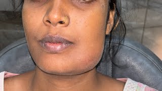 AV Malformation  Dr Arindam Mandal l 07044611705 [upl. by Perrie]