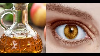 Natural Remedies to Cure Xanthelasma or Cholesterol Deposits Around the Eyes [upl. by Olatha]