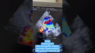 Chronic rheumatic heart disease CRHD [upl. by Nahtaneoj790]