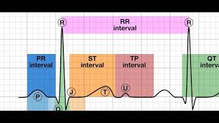 myocardial infarction stemi and nstemi [upl. by Artimid]