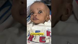 Hydrocephalus  ventricles of brain  normal pressure hydrocephalus  youtubeshorts [upl. by Fullerton]