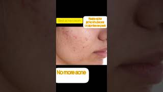 duac acne gel before and afterbest acne treatment by dermatologistacnetreatment trendingvideo [upl. by Simona560]