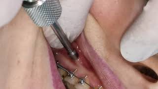 Mini screw mini implant insertion  screwing in orthodontic miniimplant TAD [upl. by Rennug]