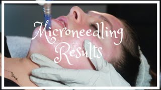 MICRONEEDLING RESULTS WORTH IT MY SKIN BEFORE DURING AND AFTER  POST TREATMENT DAILY UPDATES [upl. by Lareena]