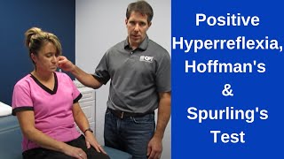 Positive Hoffmans Sign Hyperreflexia and Spurlings Test [upl. by Atnahs612]