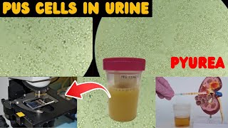 Pus cells in Urine  UTI  Urine complete examination urineanalysis [upl. by Orihakat]