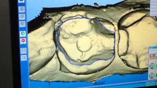 Diseño de incrustación en sistema CADCAM Cerec Godín Odontolgía Cali valle [upl. by Jala]