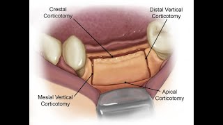 Ridge Split Surgery [upl. by Eniar393]