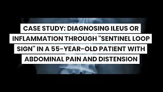 CASE STUDY DIAGNOSING ILEUS OR INFLAMMATION THROUGH quotSENTINEL LOOP SIGNquot [upl. by Curkell]